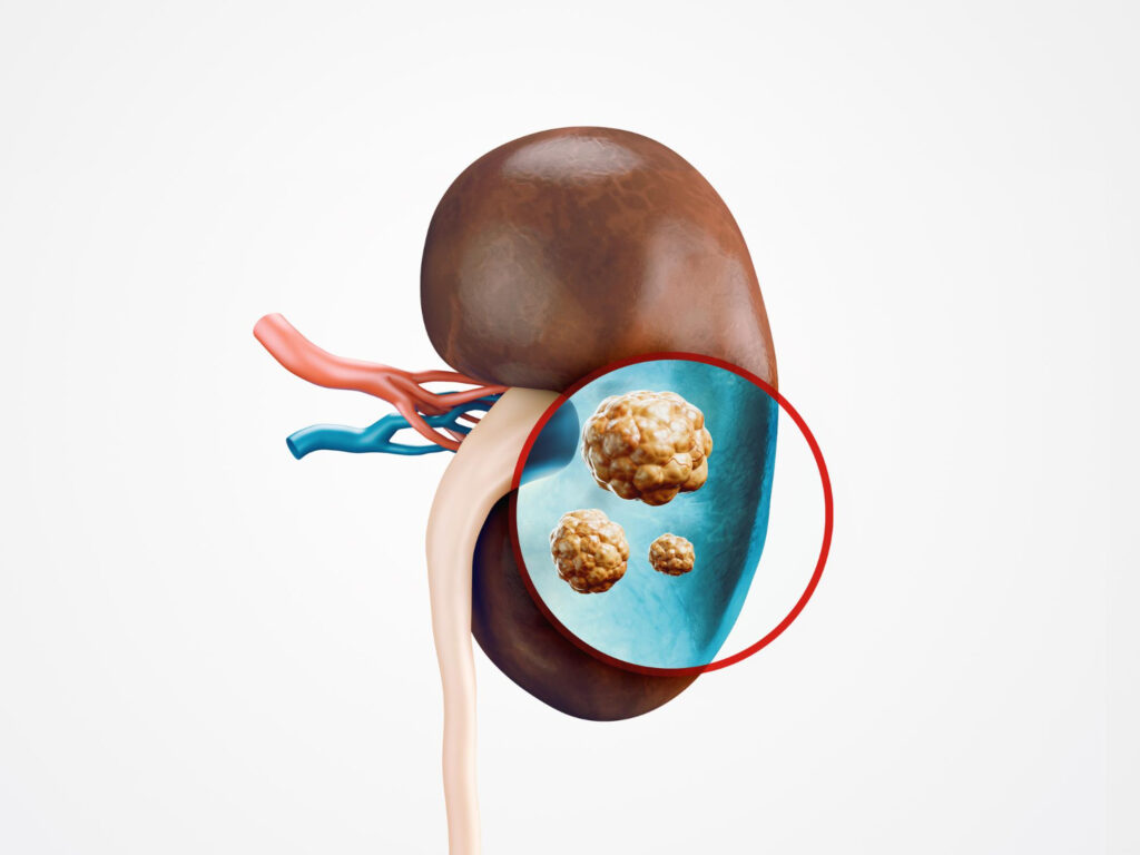 Kidney Stone Treatment